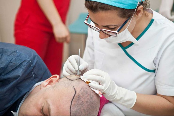 Trapianto di capelli: cosa si deve sapere prima di farlo