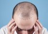 Trapianto di capelli: cosa si deve sapere prima di farlo