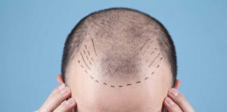 Trapianto di capelli: cosa si deve sapere prima di farlo