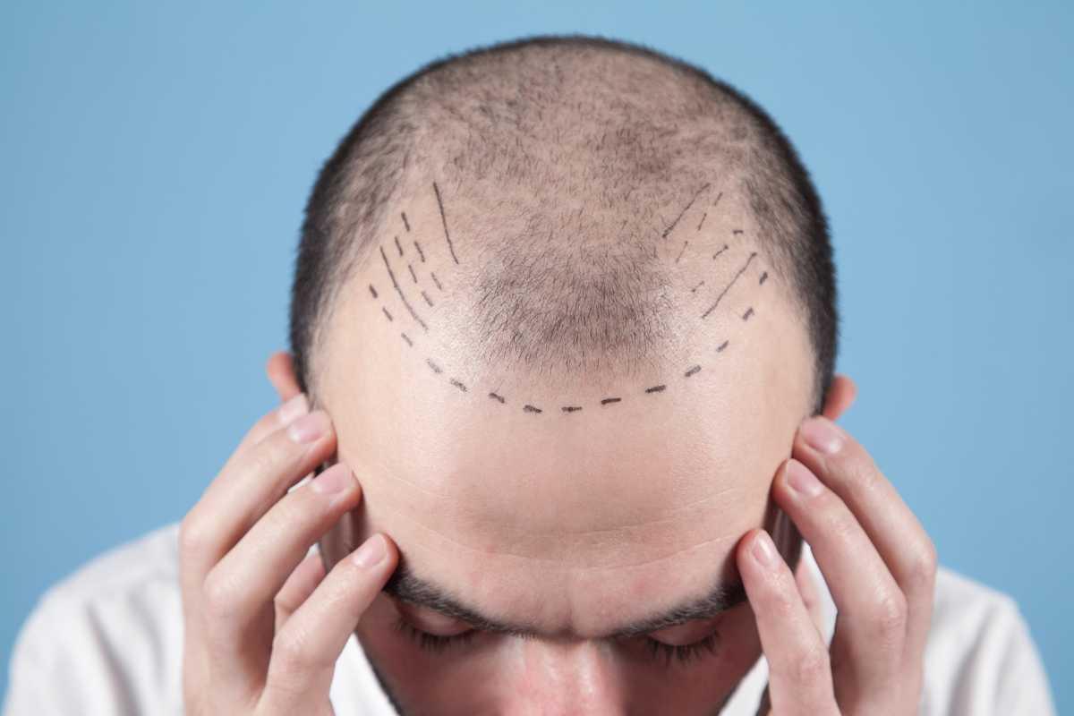 Trapianto di capelli: cosa si deve sapere prima di farlo