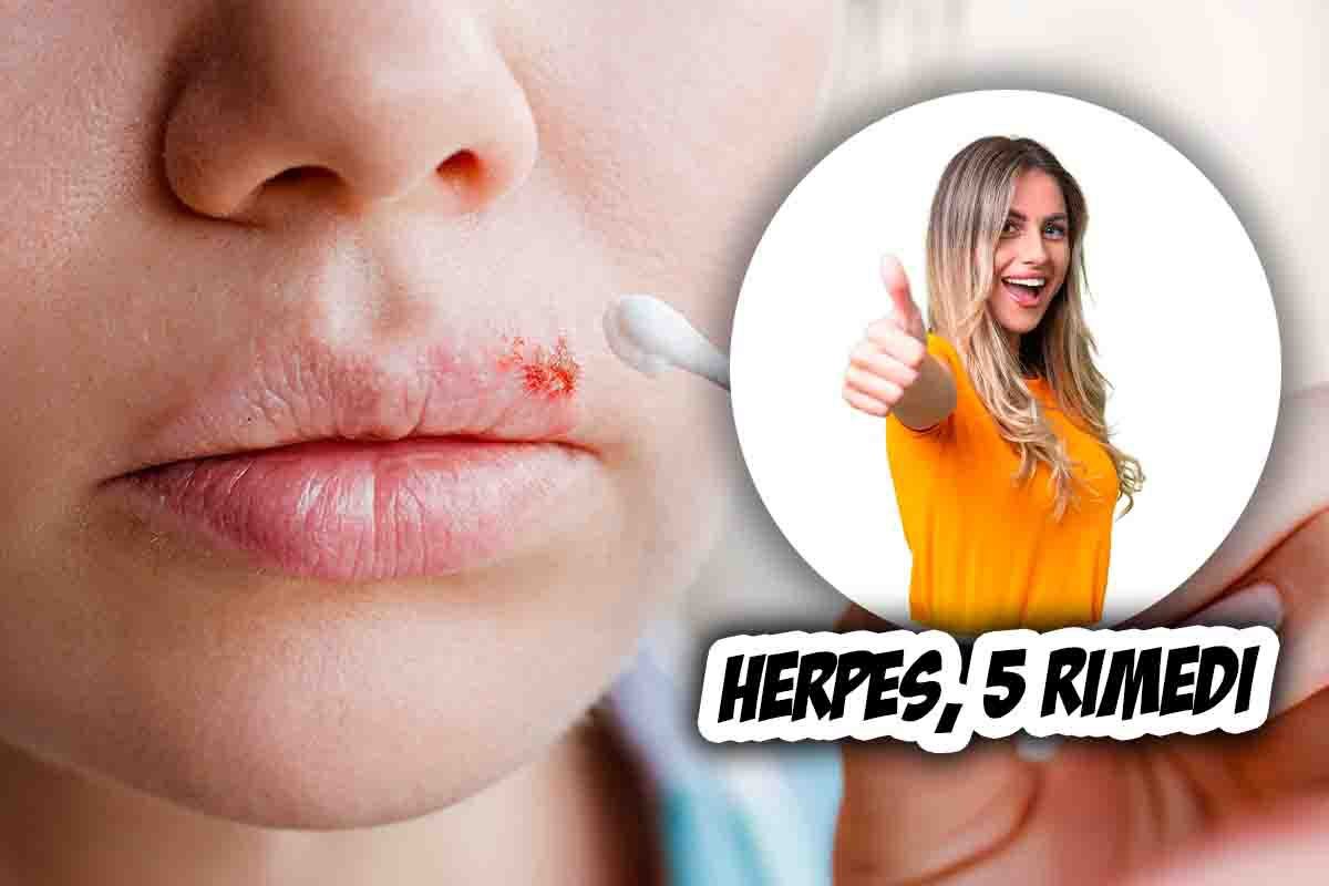 Herpes simplex, come si manifesta e come si può curare