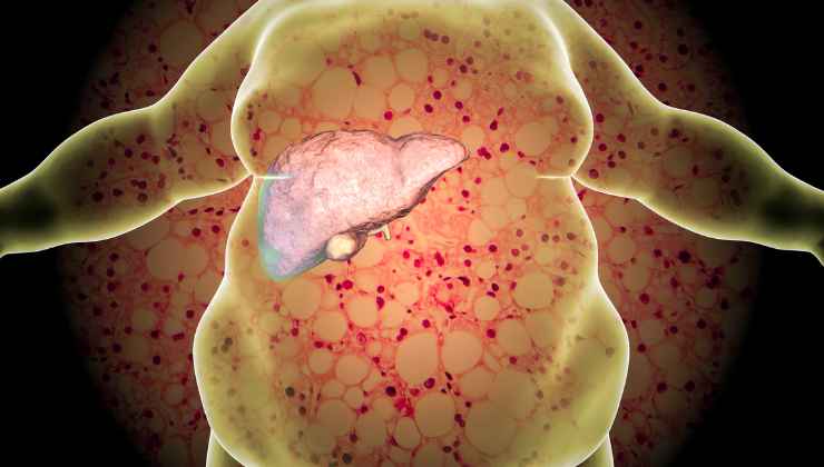La caduta dei capelli è uno tra i sintomi di una potenziale malattia al fegato