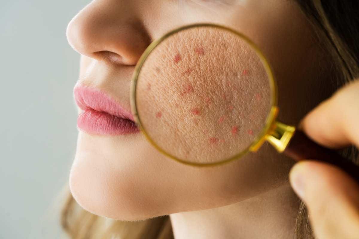 acne e punti neri problemi alla pelle del viso