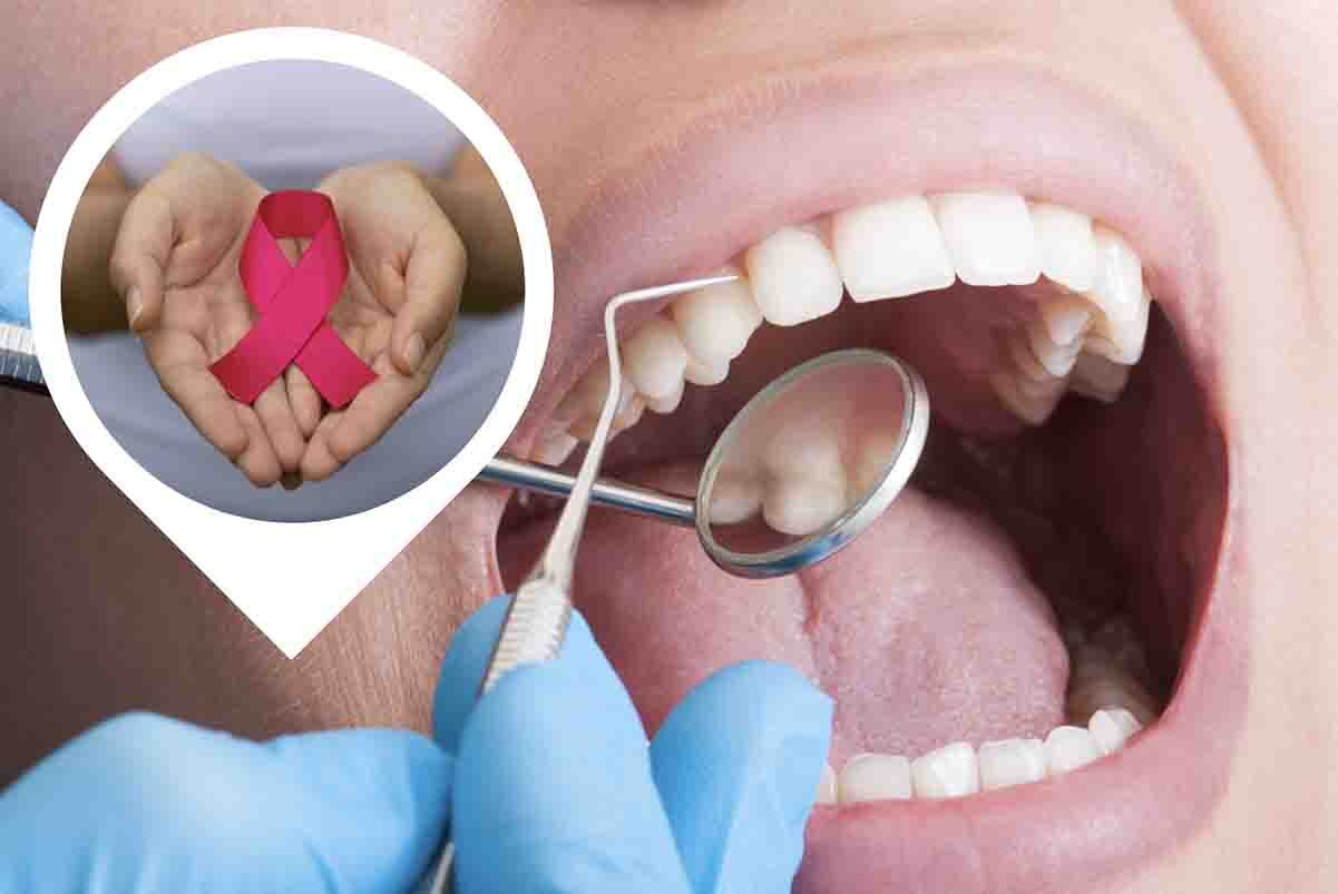 Quali sono i sintomi del cancro alla bocca