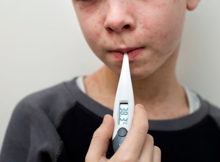 casi di morbillo in crescita nel mondo
